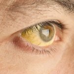 Hepatitis related jaundice Hepatitis related jaundice
